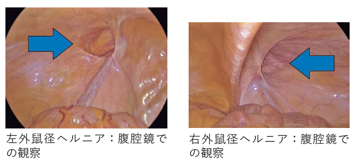 鼠径ヘルニア 腹腔鏡での観察