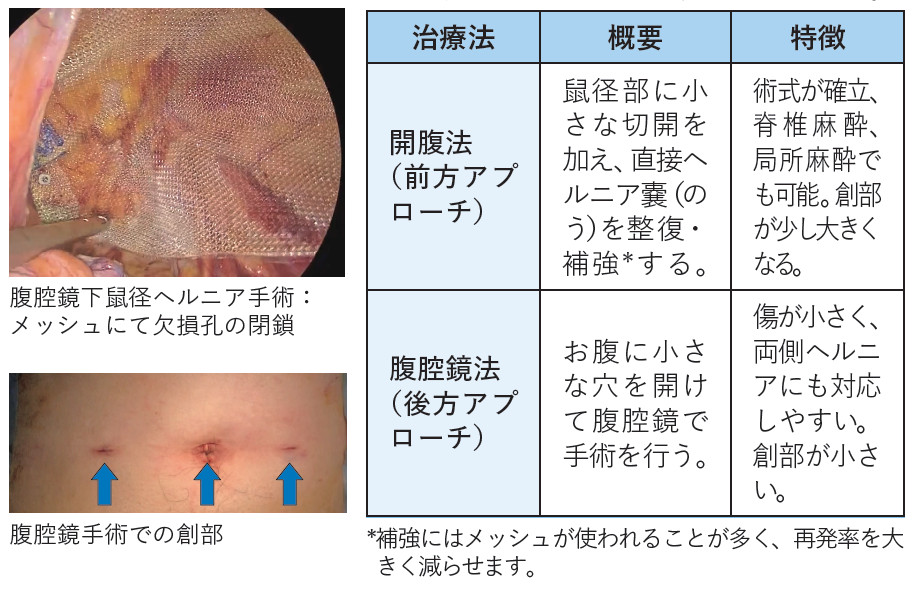 鼠径ヘルニア 治療方法
