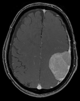 造影MRI検査 髄膜種