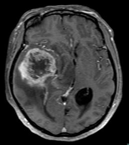 造影MRI検査 神経膠腫