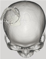 脳腫瘍の治療について　開頭術