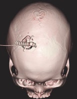 脳腫瘍の治療について　神経内視鏡手術