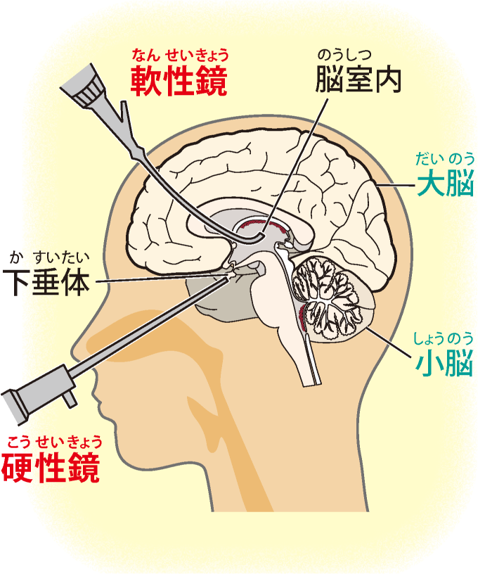 神経内視鏡手術イラスト
