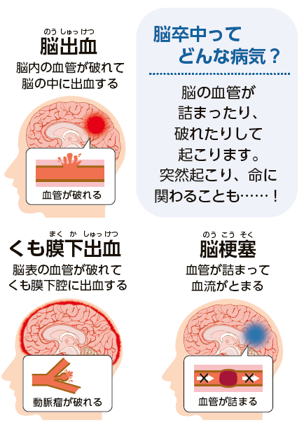 脳卒中とは