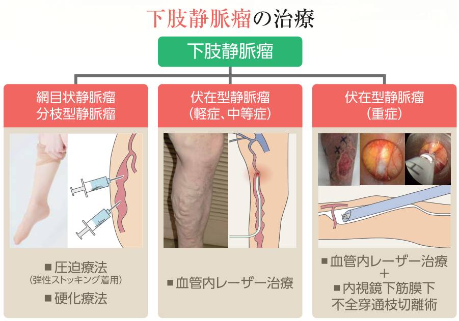下肢静脈瘤_治療