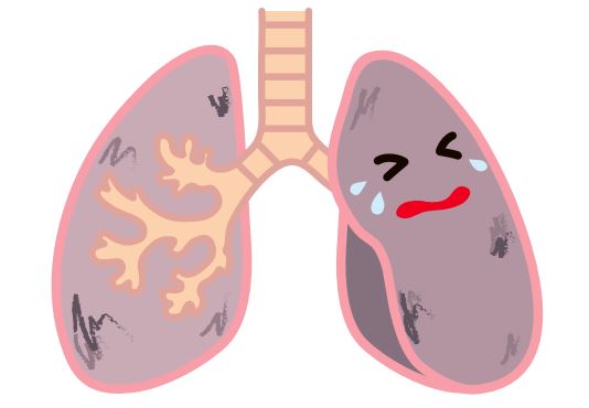 肺がんイラスト1