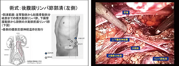 泌尿生殖器腫瘍後腹膜リンパ節転移に対する腹腔鏡下リンパ節郭清術
